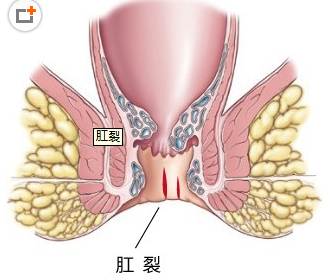 女性肛裂症状如何进行护理？