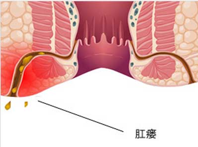 肛瘘可以不手术吗？