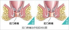 大便后肛门疼痛是为啥